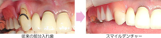 スマイルデンチャー比較